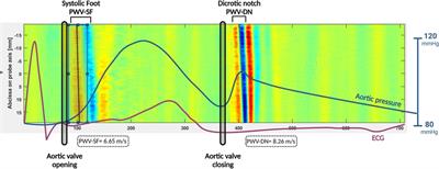 Local arterial stiffness measured by ultrafast ultrasound imaging in childhood cancer survivors treated with anthracyclines